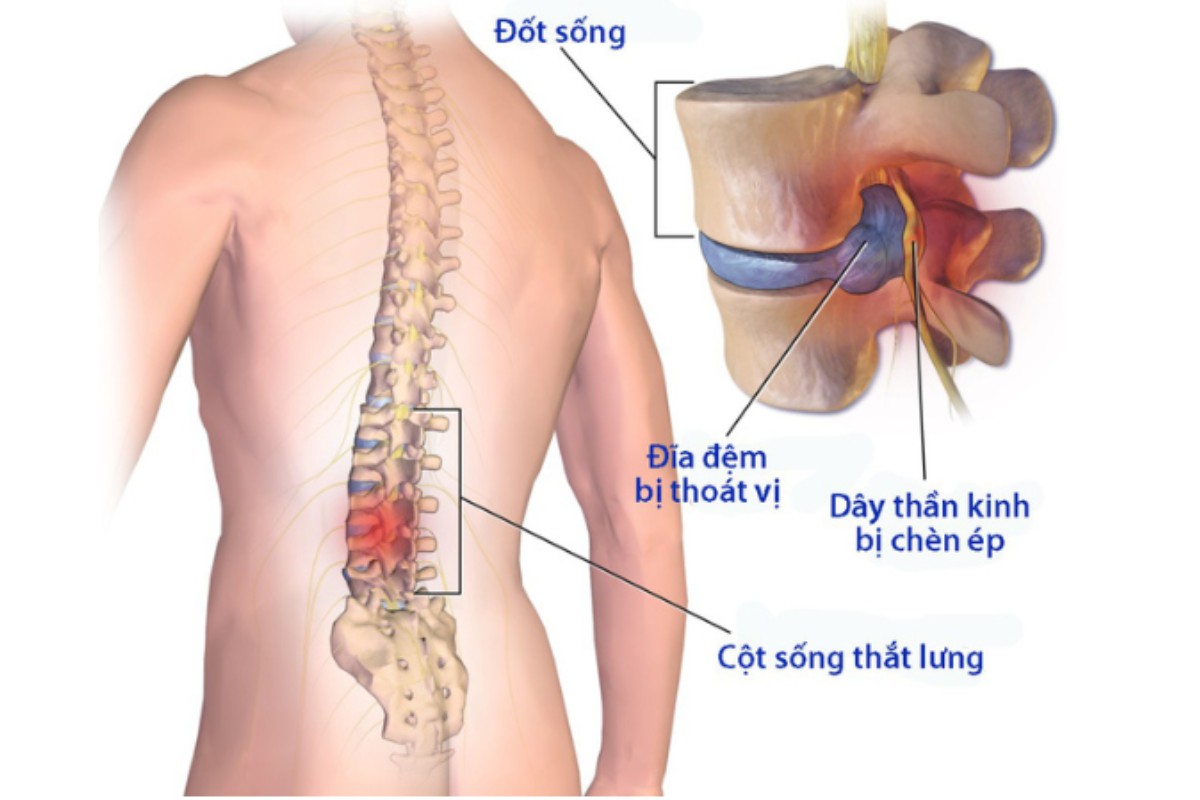 Ngồi sai tư thế gây ảnh hưởng đến cơ và xương